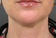 After Ultherapy skin tightening - San Diego Dermatology and Laser Surgery